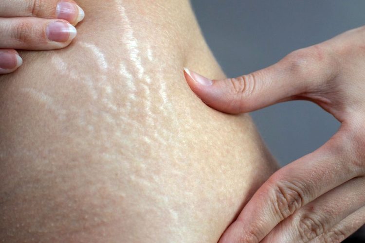 Effektive Strategien zur Vorbeugung von Dehnungsstreifen