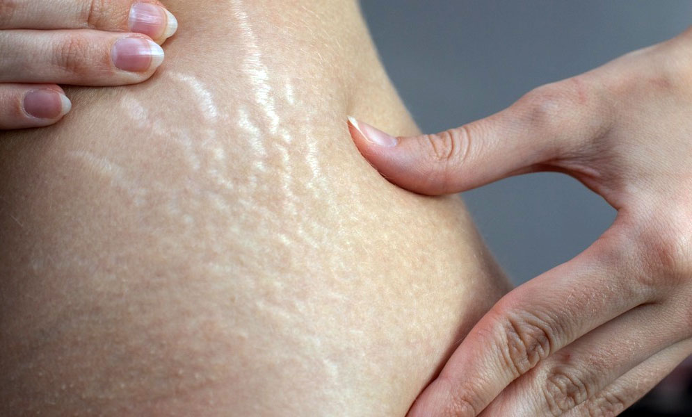 Effektive Strategien zur Vorbeugung von Dehnungsstreifen